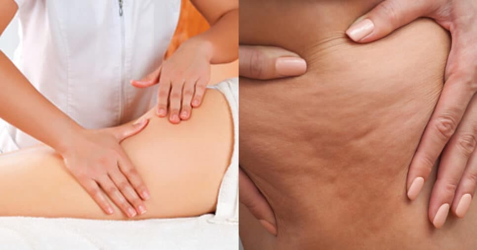 Drenagem linfática caseira: 2 bebidas populares eliminam celulite para te fazer ter pernas dos sonhos