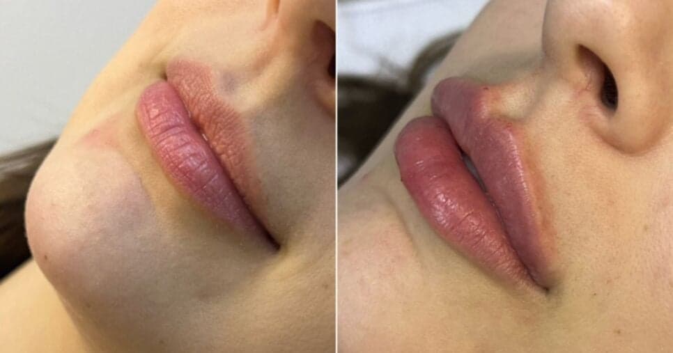 Preenchimento labial caseiro: 5 segredos infalíveis aumentam 5x os lábios sem agulhas