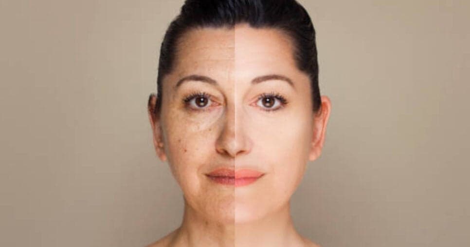 Como fazer harmonização facial caseira para eliminar rugas e linhas de expressão