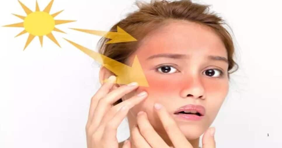 Exposição excessiva ao sol (Foto Reprodução/Montagem/Canva)