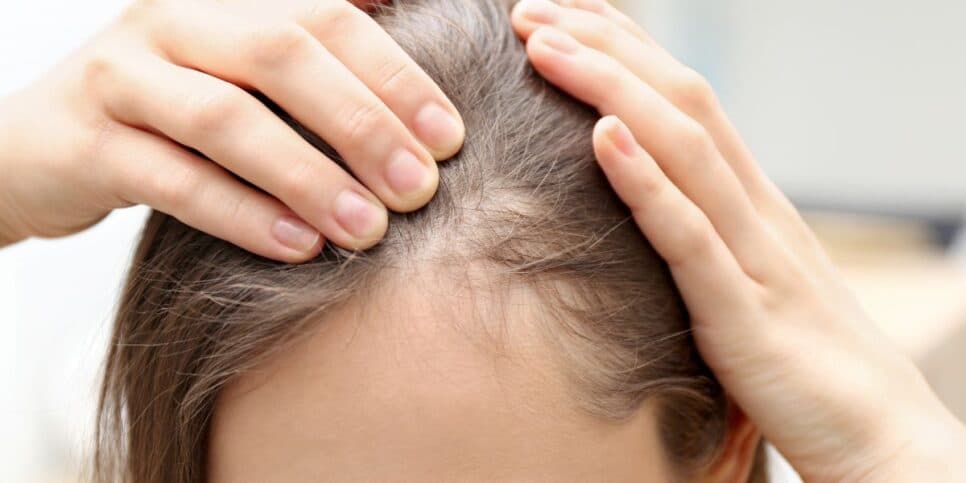Falhas no cabelo? Como esconder entradas sem química e com efeito imediato