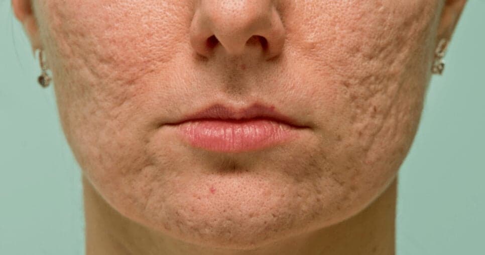 Causa irritação, manchas e piora acne: Produto popular está proibido de passar no rosto em 2025