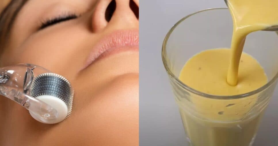 Microagulhamento facial caseiro: Mistura com 3 ingredientes traz bomba de colágeno para rejuvenescer a pele