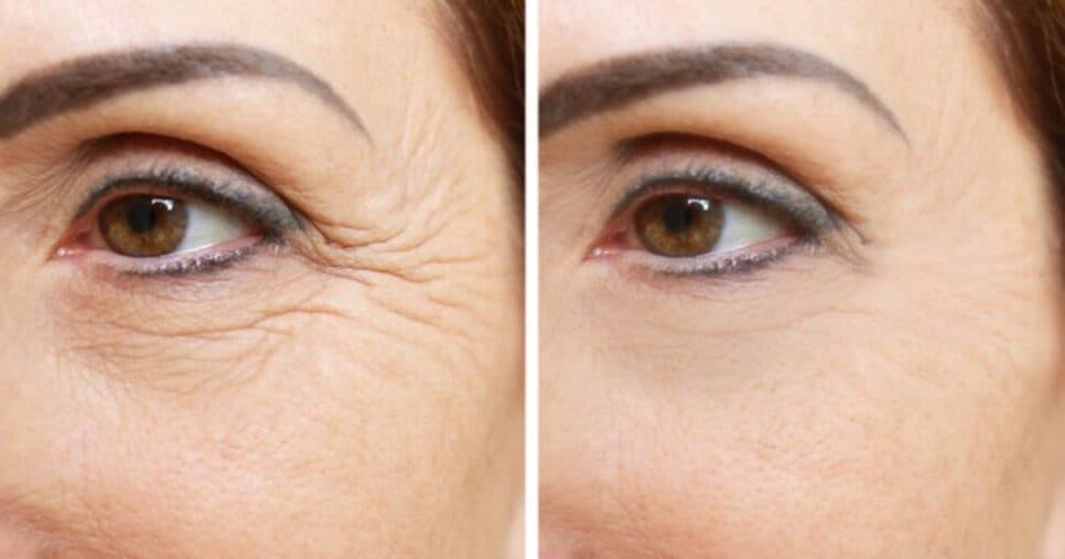 Melhor que botox: Creme natural arranca rugas de mulheres 40+ com apenas 2 ingredientes