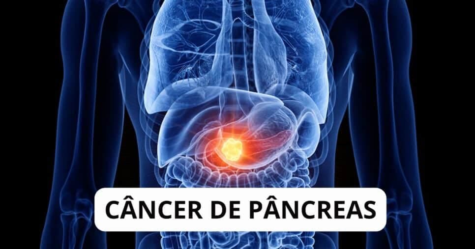 Alteração nas fezes e urina: 5 sintomas silenciosos do câncer de pâncreas