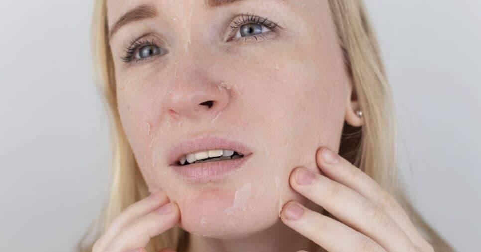 Como acabar com a pele seca no frio com 2 ingredientes que você tem em casa