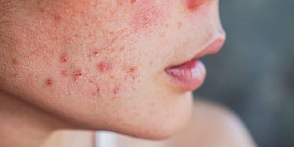 Dicas simples para diminuir a acne e melhorar a aparência da pele naturalmente