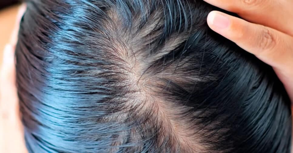 Fim do cabelo oleoso: 3 vilões da oleosidade e 3 dicas para eliminar o problema em 2025