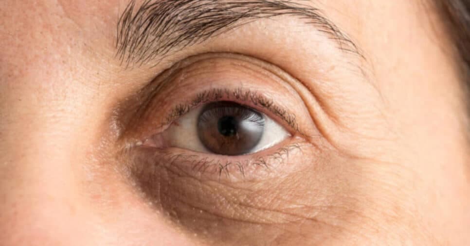 Médica revela método eficaz para se livrar de olheiras (Foto: Divulgação)