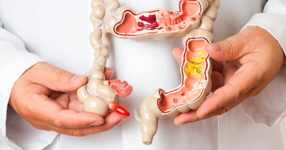 Sintomas de câncer no intestino (Foto: Reprodução)
