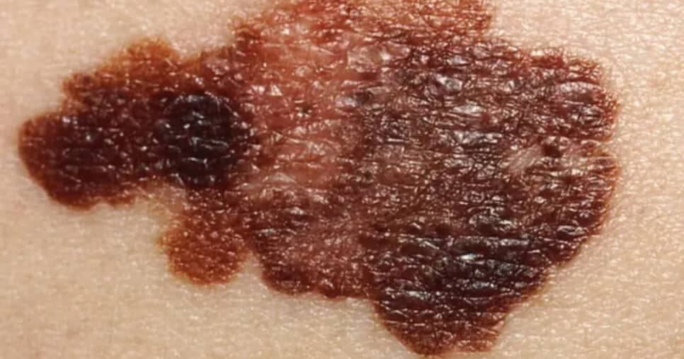 Manchas e feridas que não cicatrizam: 5 sinais de que você pode está com câncer de pele