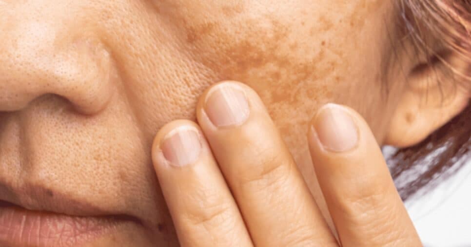 Como usar óleo natural que dá fim às manchas na pele e rejuvenesce idosos 60+