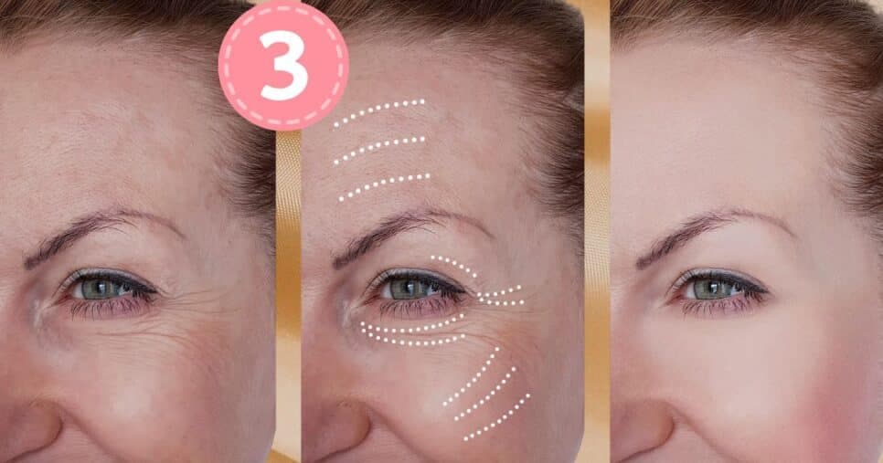 Botox caseiro com 3 ingredientes põe fim nas rugas das mulheres 55+