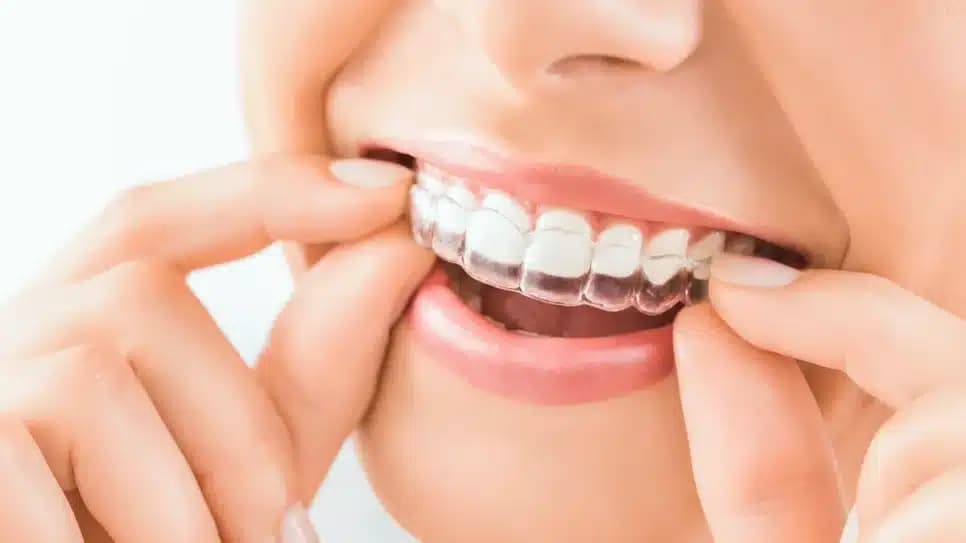 Tratamento com Invisalign (Foto: Reprodução/ Internet) Tratamento com Invisalign (Foto: Reprodução/ Internet)