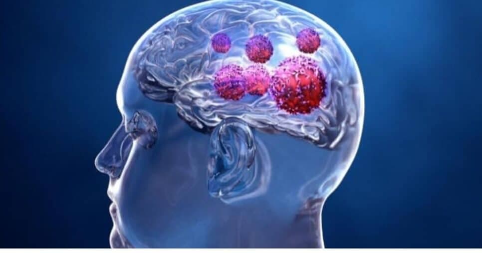 Dor de cabeça e perda de equilíbrio: 8 sintomas silenciosos do câncer cerebral