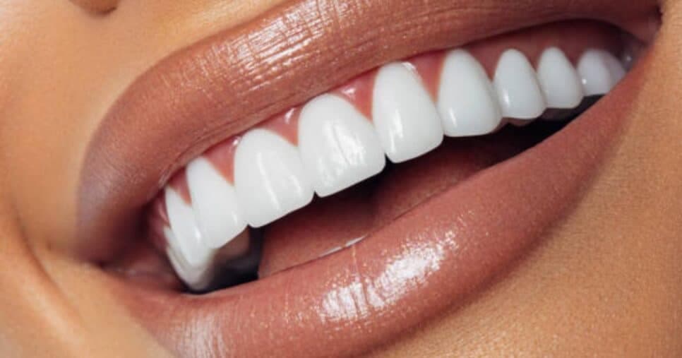 Fim do clareamento: Como ter dentes mais brancos e sorriso de estrela naturalmente