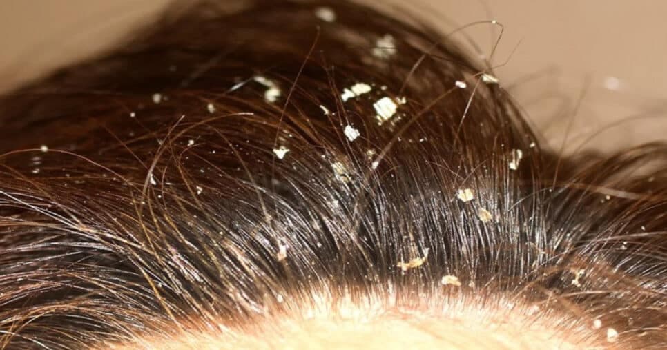 Tchau, caspa: 4 truques que ninguém te conta para se livrar de pesadelo nos cabelos