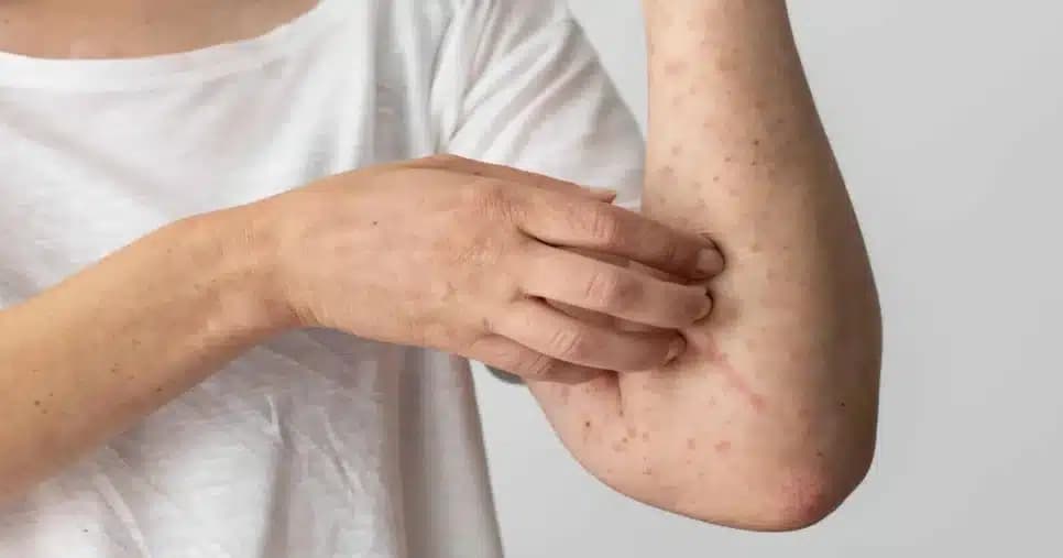 Saiba como se proteger da doença que já tem mais de 10 mil casos e mortes
