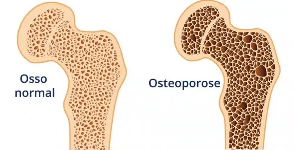 Sintomas da osteoporose (Foto: Reprodução/ Internet)