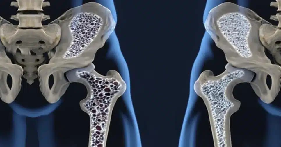 Esses são os sinais silenciosos, segundo médico, que indicam osteoporose
