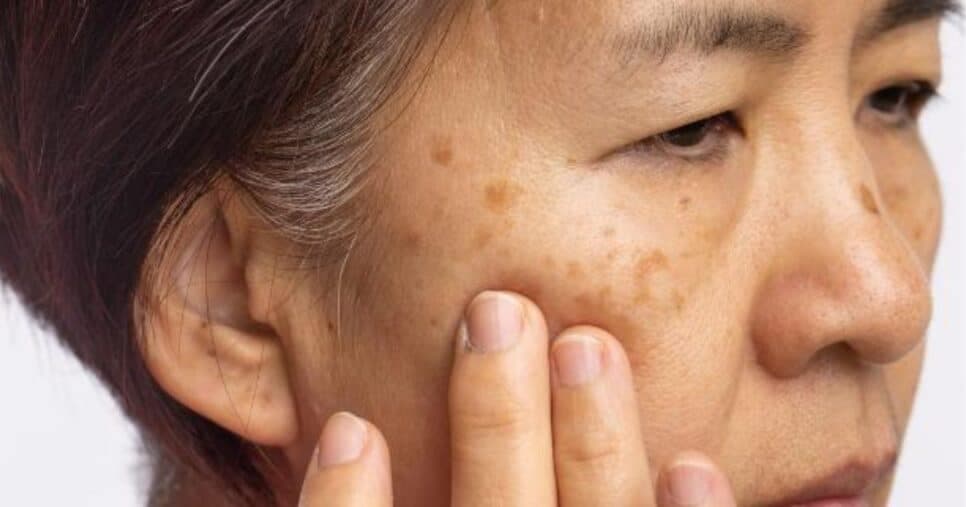 Pele de porcelana: Óleo natural reduz manchas e rejuvenesce idosas