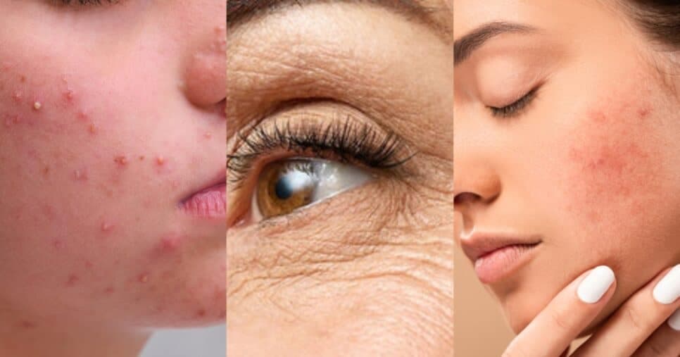 Adeus, rugas, acne e manchas: Pomada baratinha promete rejuvenescer e trazer uma pele perfeita