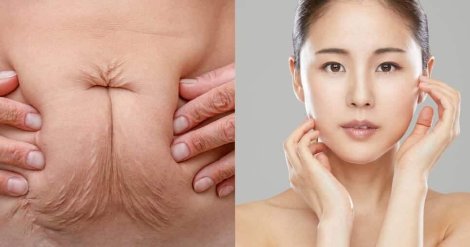 6 truques para acabar com a flacidez sem precisar de cirurgia plástica
