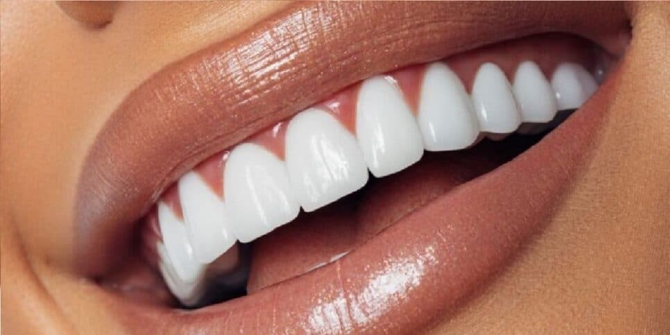 Por que o uso de gel caseiro pode ajudar a clarear os dentes brancos sem precisar de carvão ativado