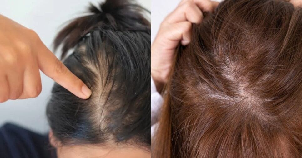 Dermatologistas revelam: O erro que faz seu cabelo parecer mais fino