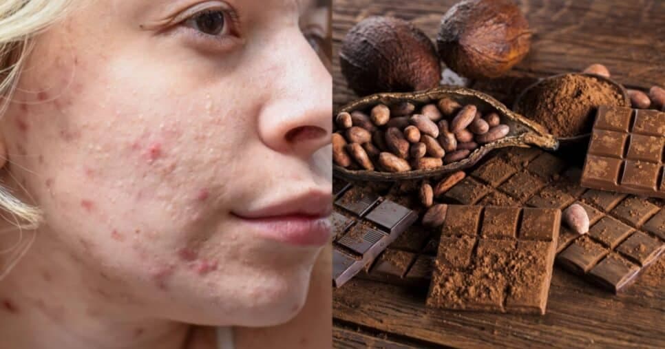 Consumir chocolate pode causar mais espinhas? Especialistas explicam