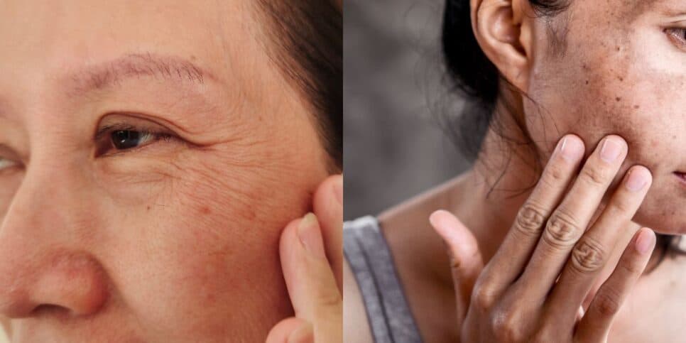 Sou dermatologista e conto: O que ninguém te diz sobre rugas e manchas