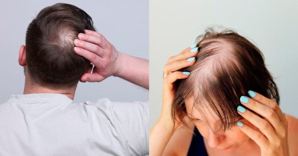 Devolvem a juba perdida: 3 óleos para acabar com a calvície e voltar a ter cabelo em 2025