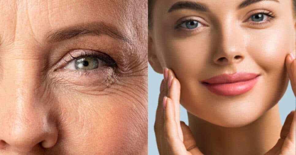 Rosto de 30 para sempre: Harmonização caseira com 2 ingredientes suga rugas das mulheres