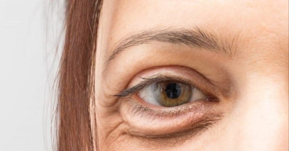 Chega de olheiras e bolsas nos olhos: Dermatologista revela métodos que funcionam