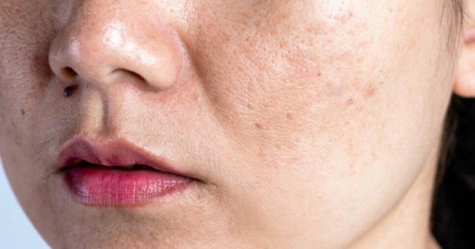 Misturinha com 3 ingredientes traz botox natural e fim das rugas e manchas na pele das mulheres