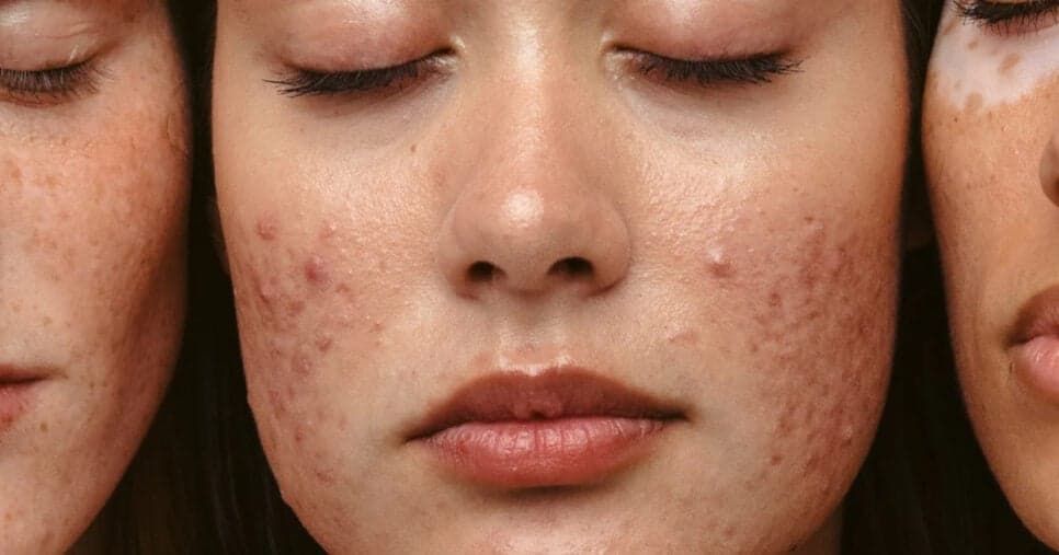 Tchau, espinhas e para ter rosto de porcelana: Misturinha com apenas 2 ingredientes revitaliza sua pele