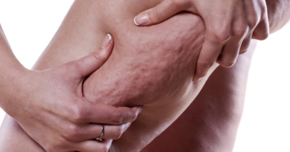 Tchau, celulite: Único ingrediente infalível ameniza problema das 40+ e te dá pernas dos sonhos