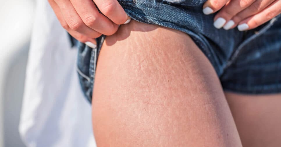 Piora as estrias: 3 hábitos que estão causando mais marcas na sua pele