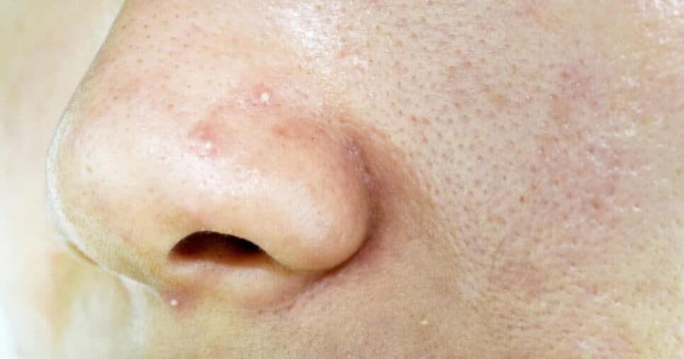 6 dicas impecáveis para fechar poros dilatados e ter pele de porcelana