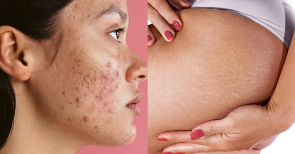 Fim da acne e estrias: Óleo popular clareia as manchas da pele sem sair de casa
