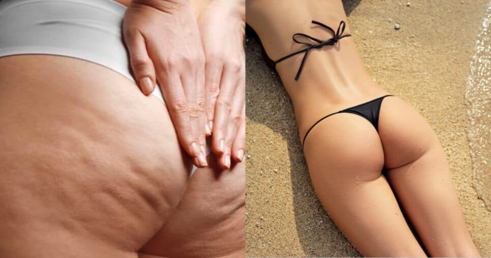 Adeus, celulite: 3 produtos de farmácia que deixam pernas lisinhas para o Verão