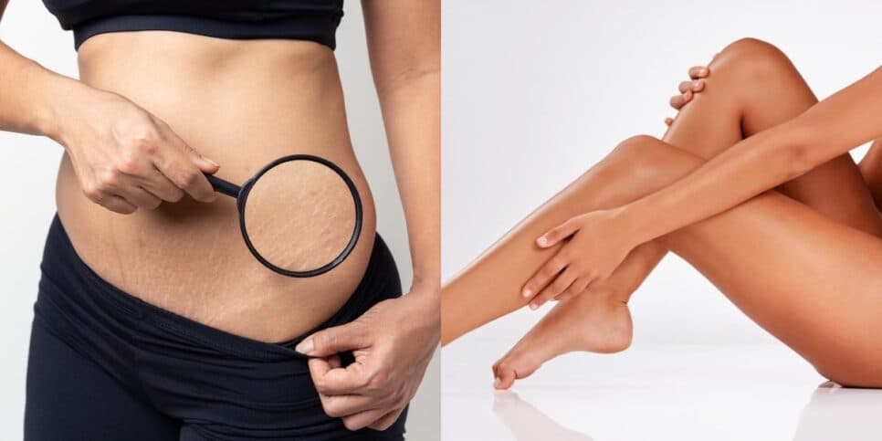 Pele de bebê: 3 dicas rápidas para disfarçar estrias e arrasar no verão