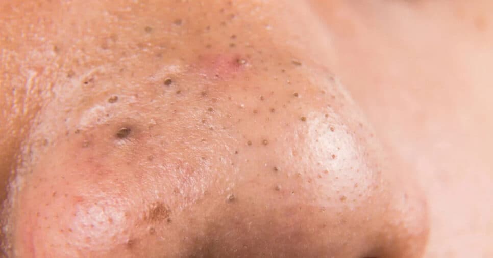 Tchau cravos e buraquinhos no rosto: 5 truques infalíveis para eliminar problema e ter pele de bebê
