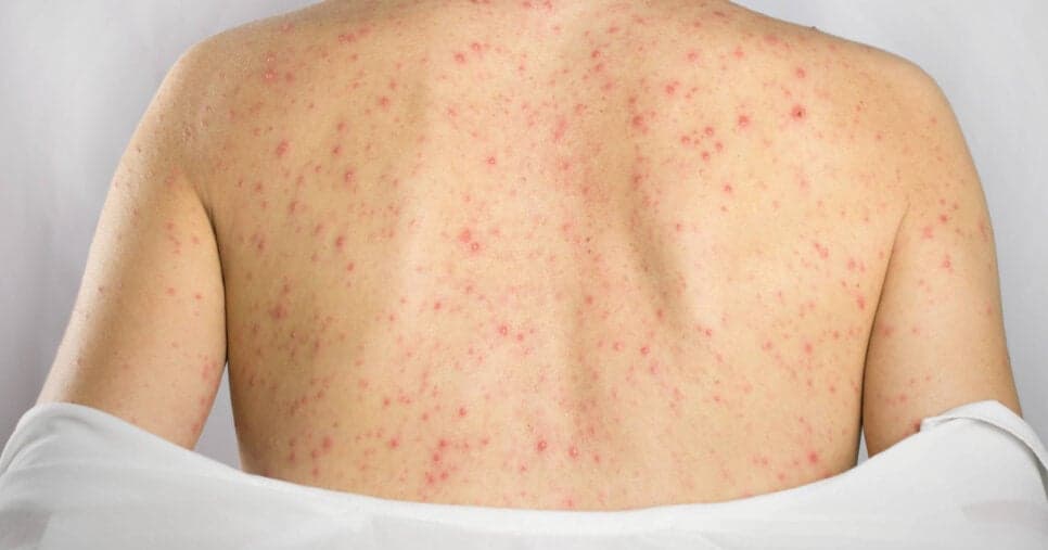 Fim do pesadelo: 5 truques para acabar com as espinhas nas costas