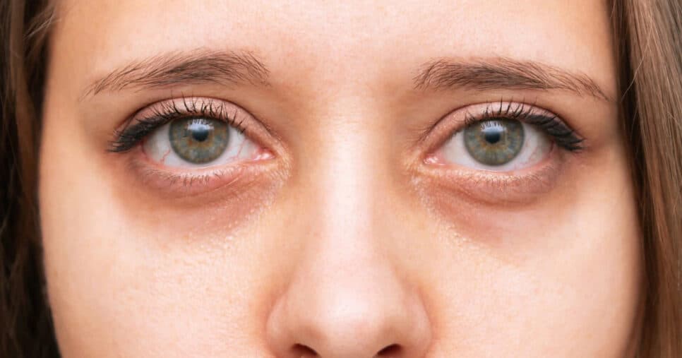Nada de agulhas: 5 dicas definitivas para reduzir as olheiras em casa