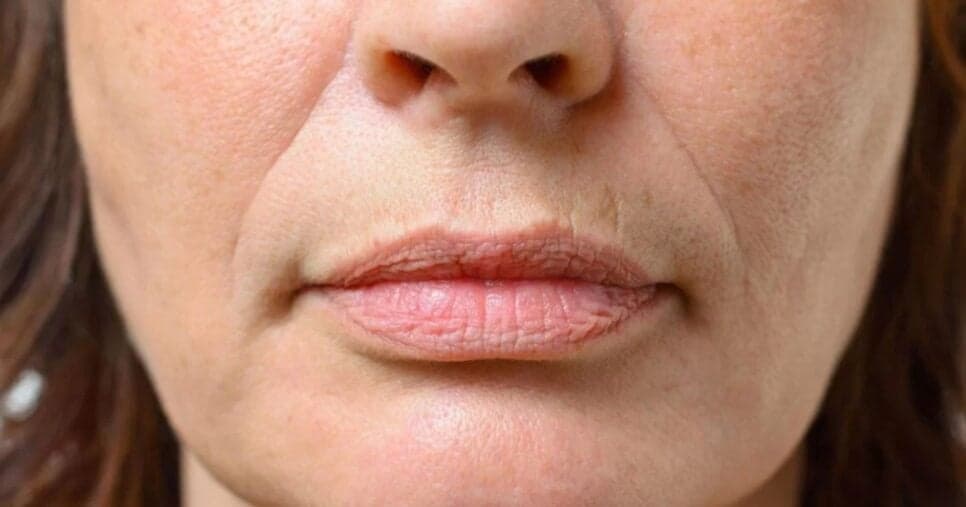 Adeus ao bigode chinês: Como usar creme da Nívea para preencher rugas da face em casa