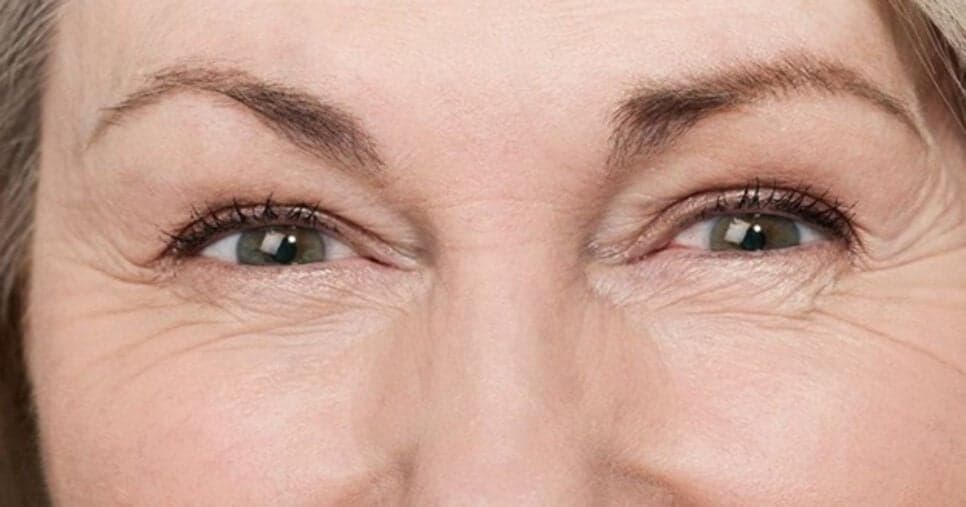 Fim dos pés de galinha: 5 truques para acabar com rugas em casa e rejuvenescer 10 anos