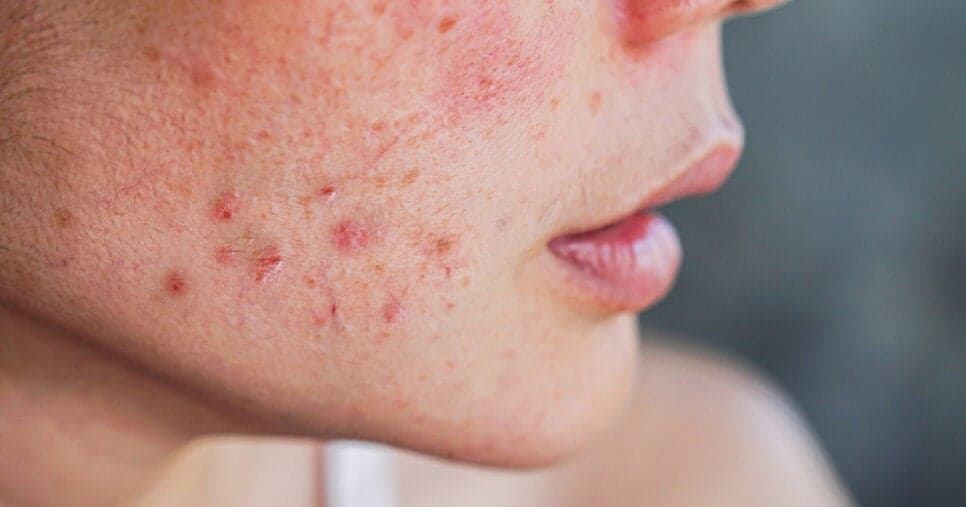 Causam espinhas na pele: 5 vilões que estão acabando com o seu rosto