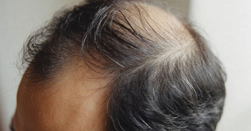 Cabelo com falhas (Foto: Canva)