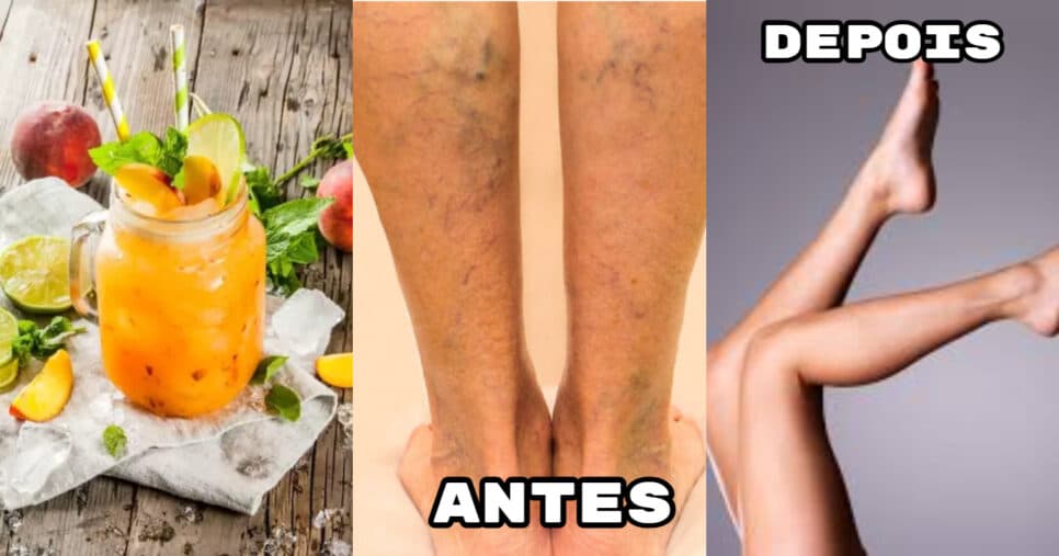 Adeus às varizes: Suco infalível com único ingrediente popular elimina manchas na perna das 40+